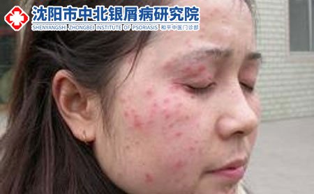 牛皮癣会不会长在脸上