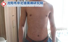沈阳中北银屑病研究院好吗？