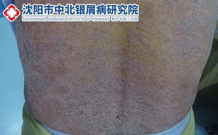 沈阳银屑病医院