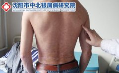 沈阳中北银屑病研究院怎么样