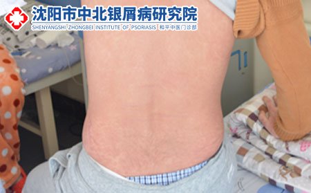 银屑病会不会传染