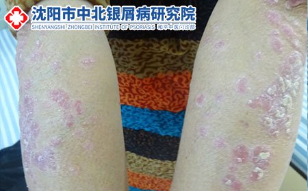 男性得了牛皮癣能要孩子吗