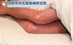银屑病会遗传吗?遗传概率有多大
