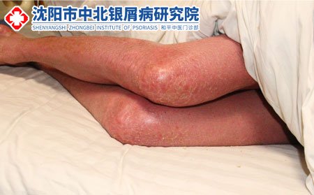 银屑病会遗传吗