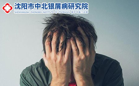 牛皮癣能不能治好