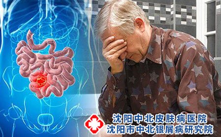 老年牛皮癣患者日常护理应注意什么