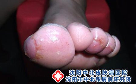 脚气怎么治疗