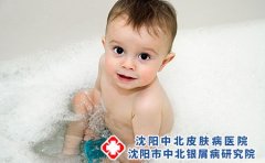 父亲患有银屑病会不会遗传孩子