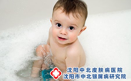 父亲患有银屑病会不会遗传孩子