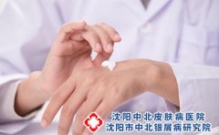 银屑病护理的四个小常识是什么？