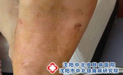 湿疹会不会传染