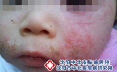 小儿湿疹反复发作的5个因素