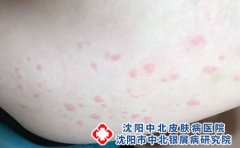 荨麻疹的症状是怎样的?