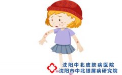 宝宝湿疹应该注意什么?