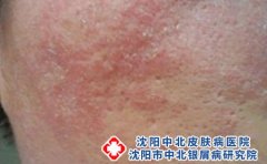 火锅美味，易引来皮肤过敏
