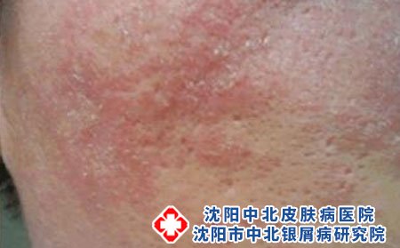 火锅美味，易引来皮肤过敏