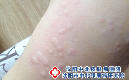 容易皮肤过敏该吃些哪些好