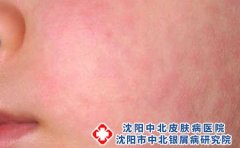 怎么样诊断是不是皮肤过敏
