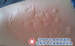 自己为什么会皮肤过敏?