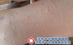 皮肤过敏怎么止痒呢