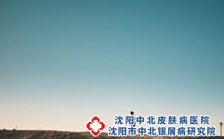 神经性皮炎的治疗方法有哪些?饮食注意什么?