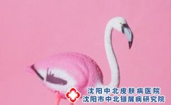 小儿荨麻疹应该如何治疗?