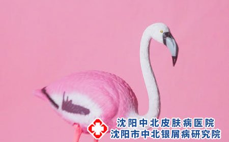 小儿荨麻疹应该如何治疗?