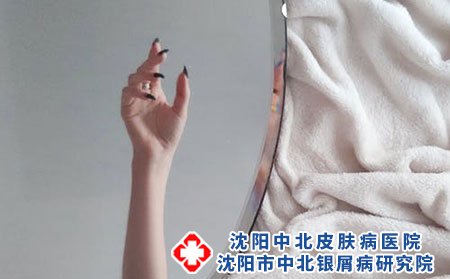 婴儿湿疹要多注重母乳喂养