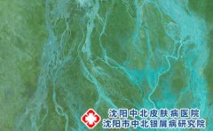 预防婴儿湿疹要防患于未然