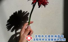 预防脚气要从平常生活中做起