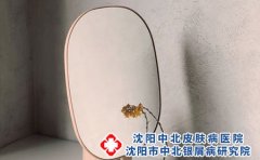 为什么会得足癣?预防足癣复发应该怎么做?