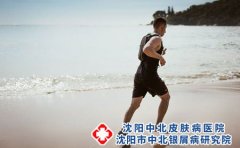 什么是脚气?脚气容易复发怎么办?